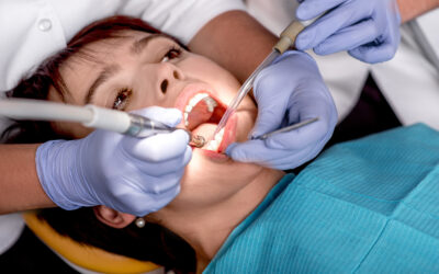 Dental Sealants: What Are They And Do I Need Them?